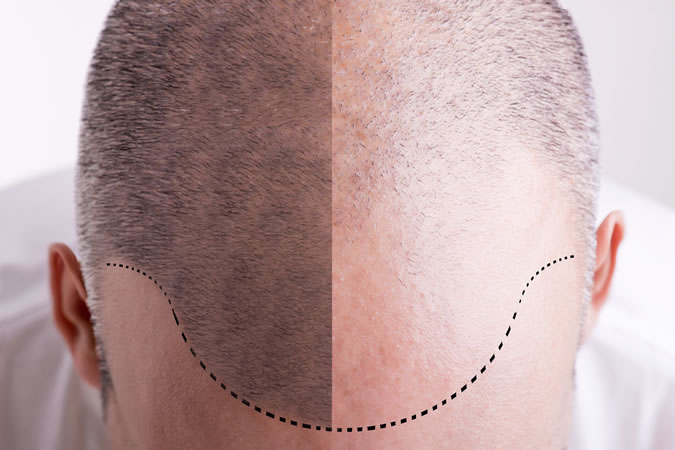Hair Transplant