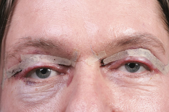 Blepharoplasty