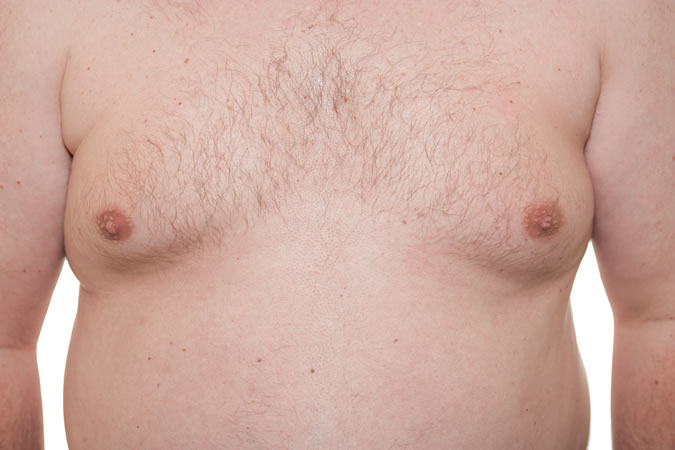 Gynaecomastia Surgery (Male Breast Reduction)