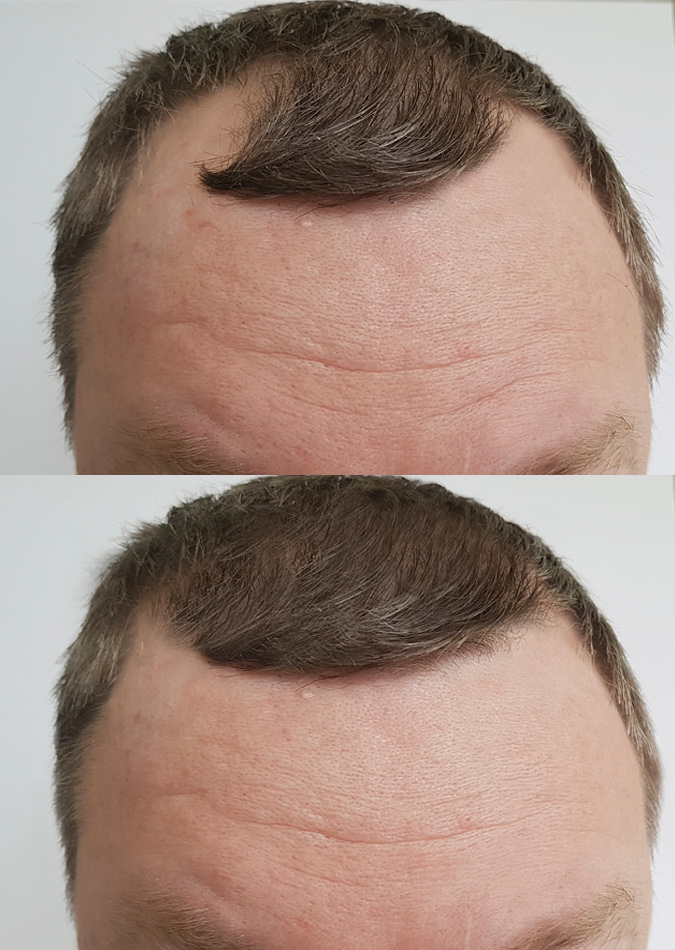Hair Transplantation