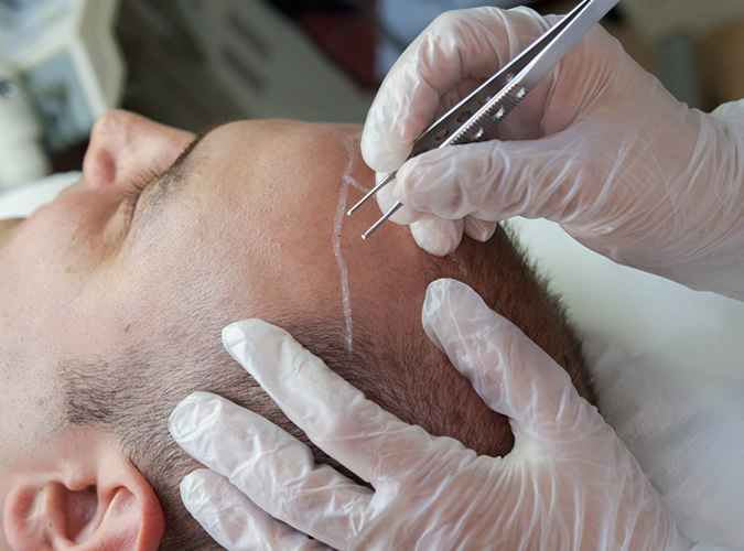 Hair Transplant